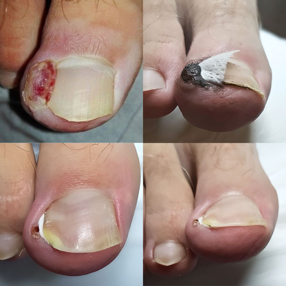 Terapia wrastajacego paznokcia