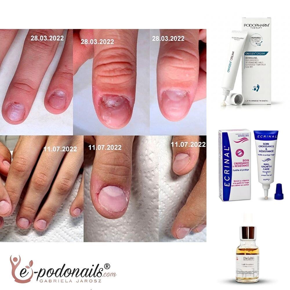 Onygen® Skuteczny Krem na Onycholizę 