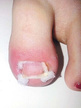  Ligasano® tamponada - wrastające paznokcie rolka 3 m x 5cm x 0.3 cm  (4)