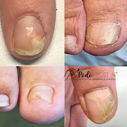 Onycholiza paznokci dłoni i stóp - co to jest? Objawy i proces leczenia | PodoNAILS®