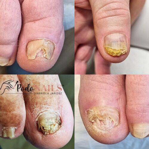 Grzybica paznokci nóg - czym jest i jak leczyć? Przyczyny, objawy | PodoNAILS® 